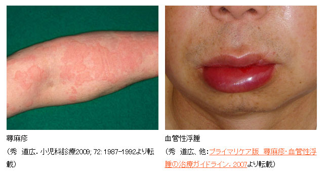 蕁麻疹・血管性浮腫